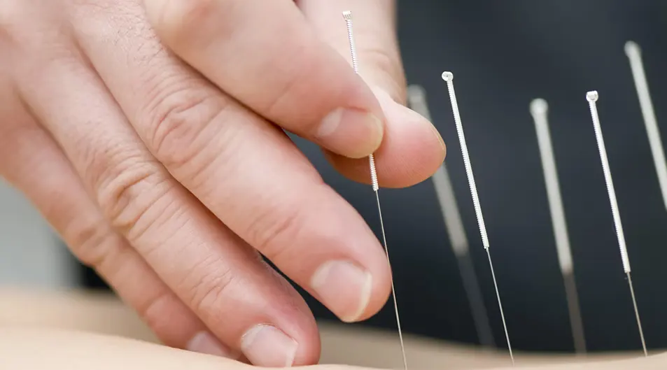 Medical Acupuncture in Vaughan