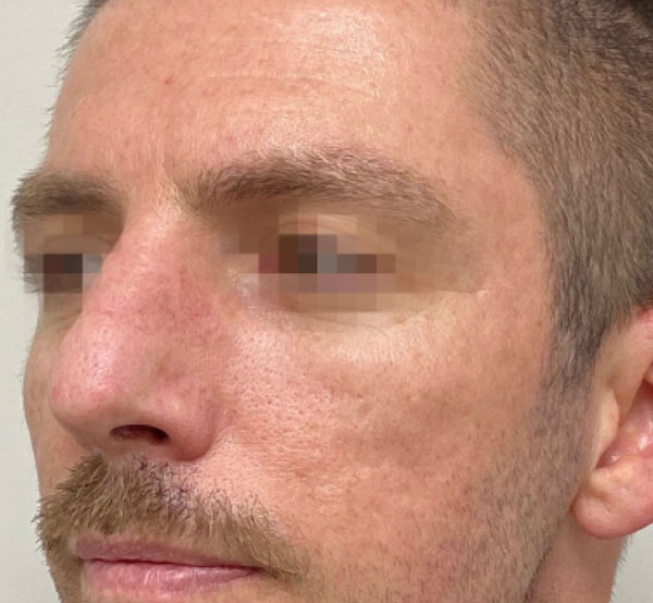After 3 Treatments