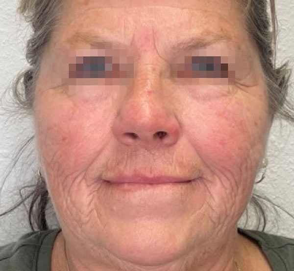 After 3 Treatments