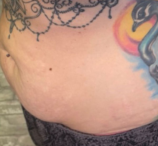 After 4 Treatments