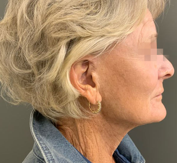 After 3 Treatments