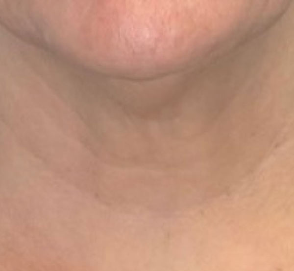 After 3 Treatments