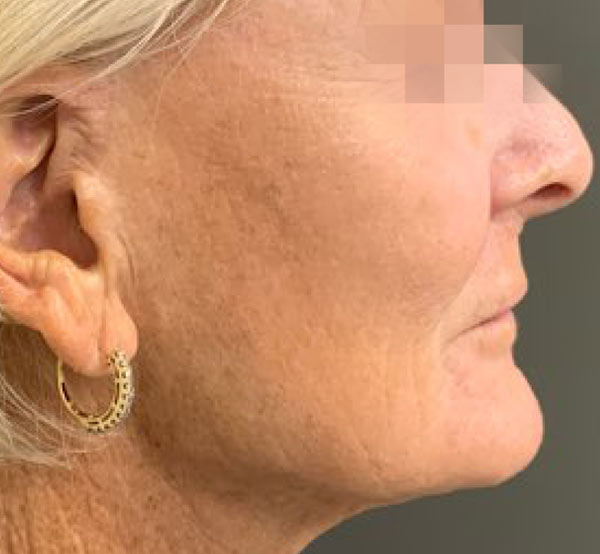 After 3 Treatments