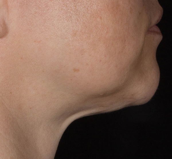 After 1 Treatment