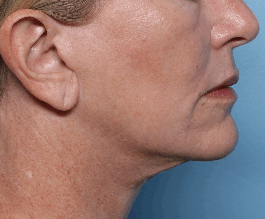 After Skin Tightening in Toronto