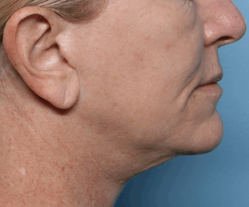 Before Skin Tightening in Toronto