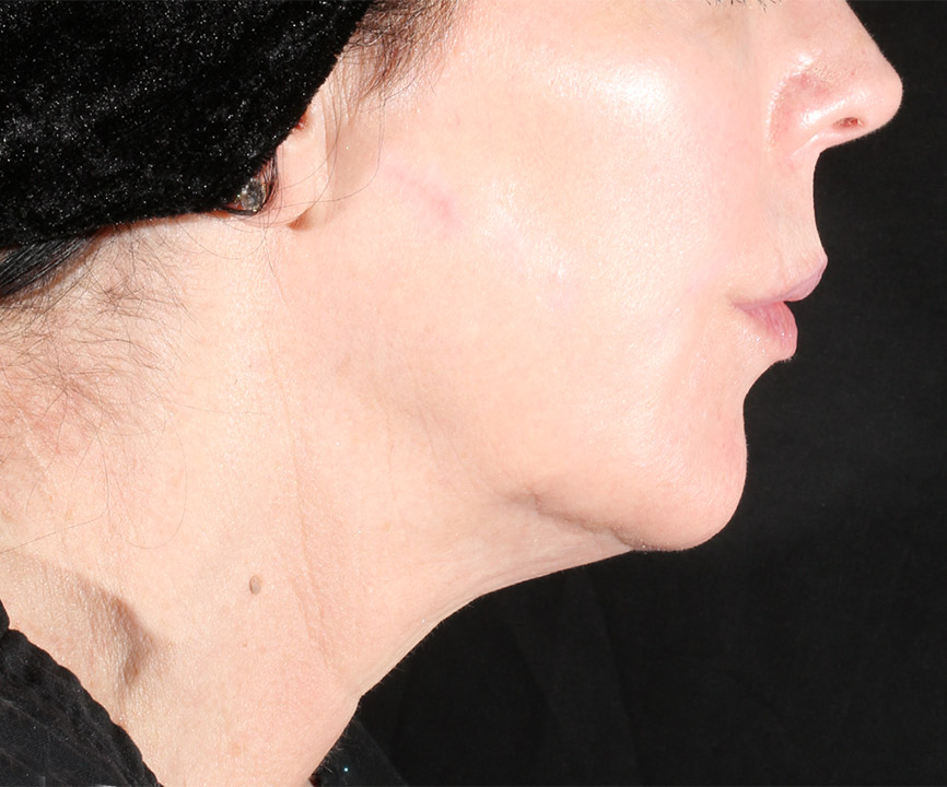Fter XERF Skin Tightening