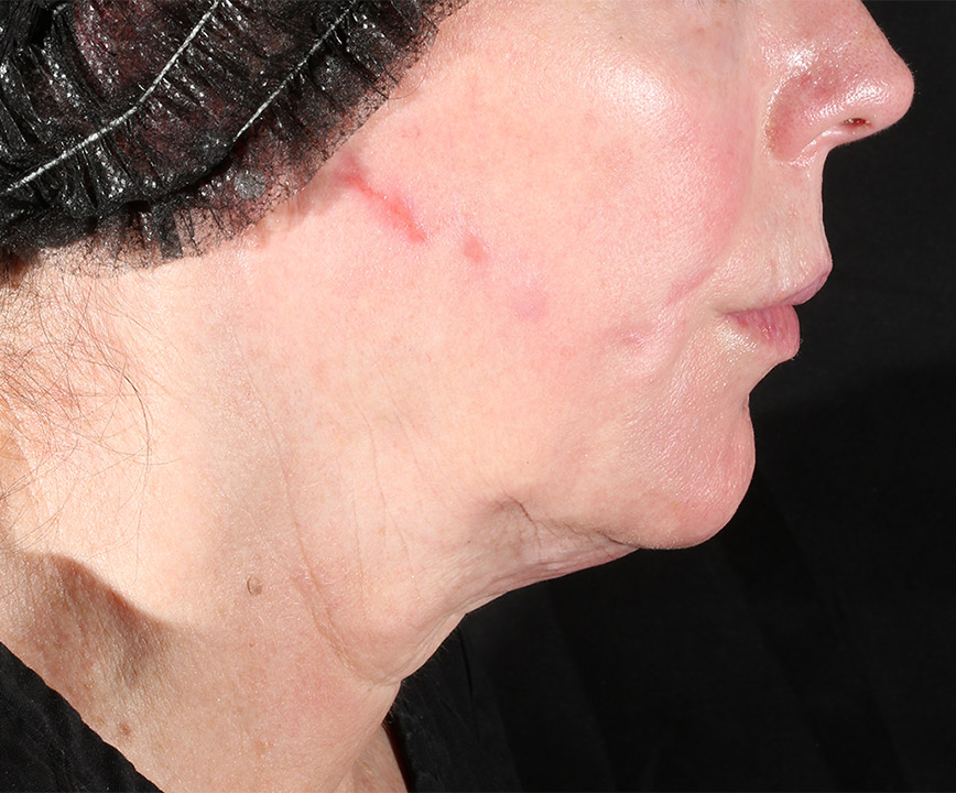 Before XERF Skin Tightening